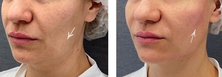 Неинвазивный RF лифтинг - частное объявление в Балашиха