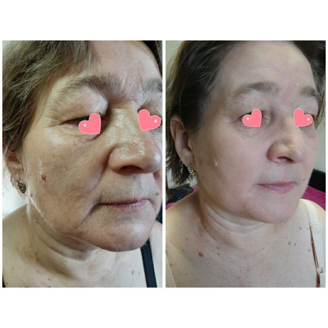 Безоперационная подтяжка лица - Красота и здоровье в Улан-Удэ