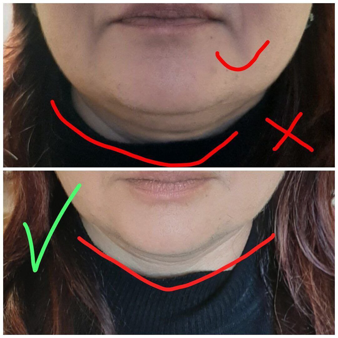 Безоперационная подтяжка лица - Красота и здоровье в Улан-Удэ - фото 3