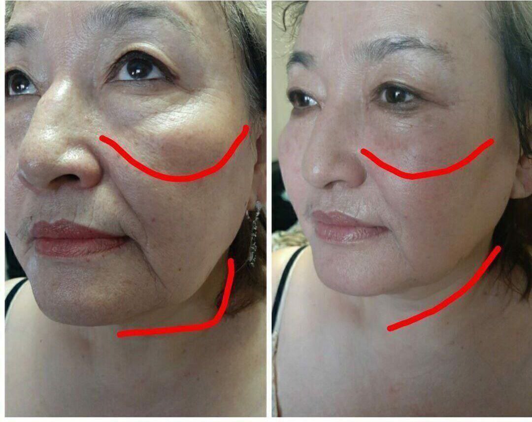 Безоперационная подтяжка лица - Красота и здоровье в Улан-Удэ - фото 5