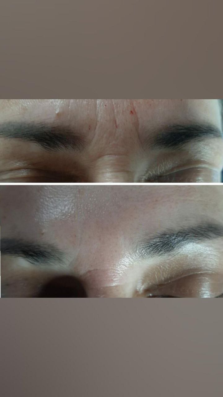 Безоперационная подтяжка лица - Красота и здоровье в Улан-Удэ - фото 6