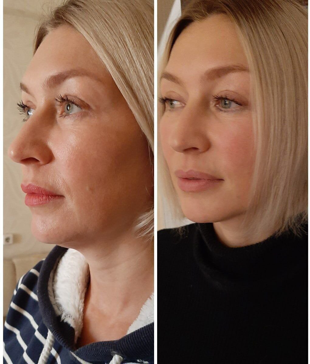 Безоперационная подтяжка лица - Красота и здоровье в Улан-Удэ - фото 7