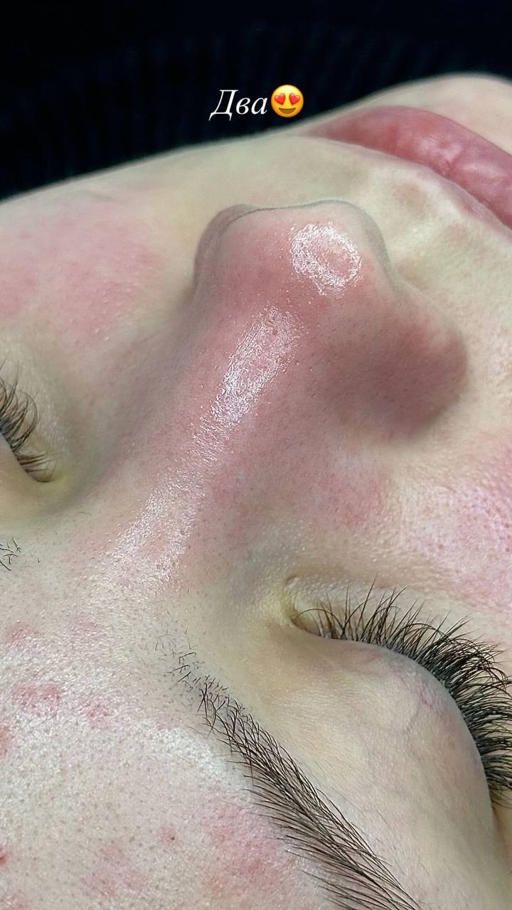 Чистка лица - Красота и здоровье в Казань - фото 3