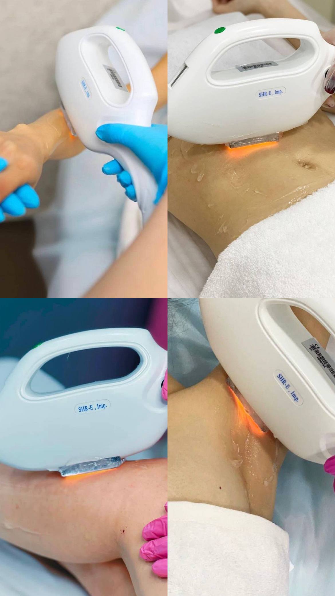 Лазерная эпиляция ЭЛОС - Красота и здоровье в Беляниново (Мытищи)