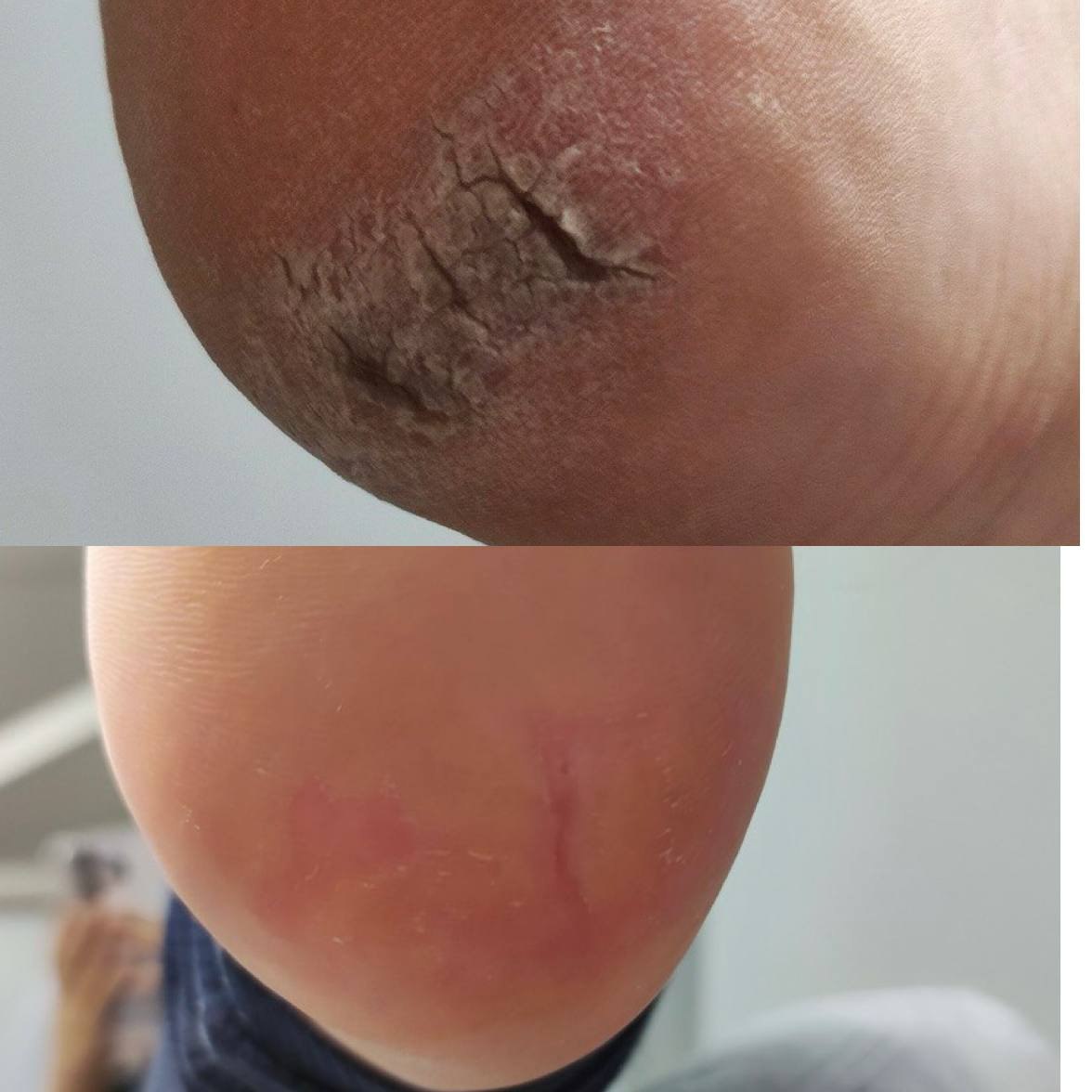 Профессиональная подология для здоровья ног - Услуги в Иркутск - фото 2