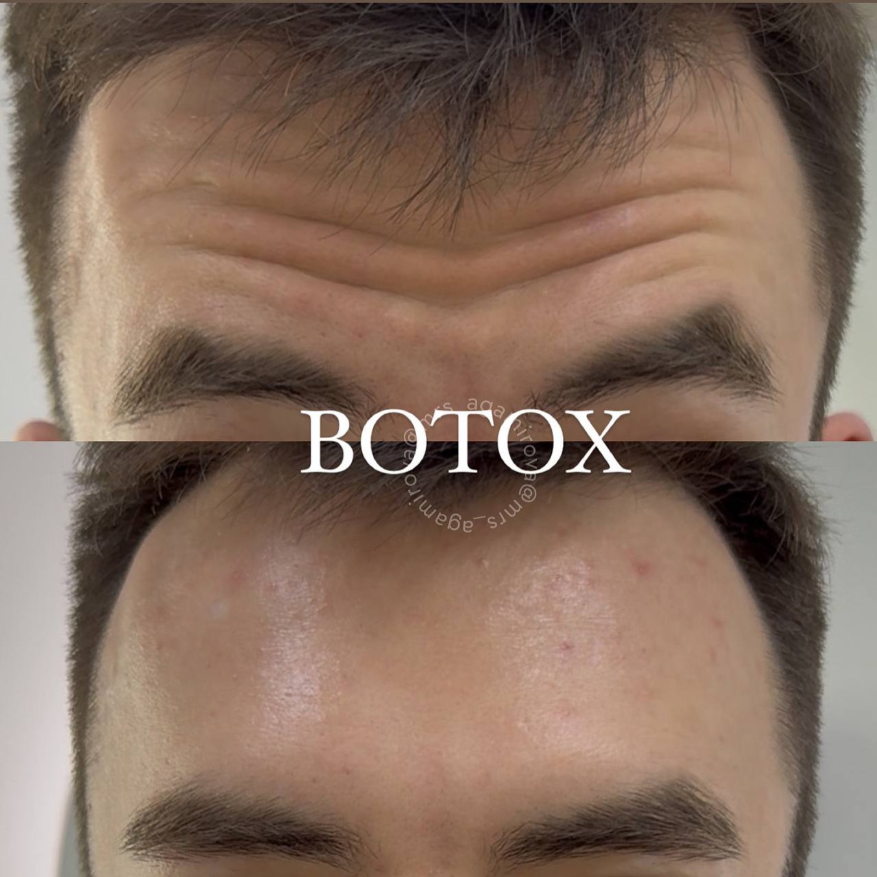 Ботокс лоб+межбровье - Красота и здоровье в Люберцы