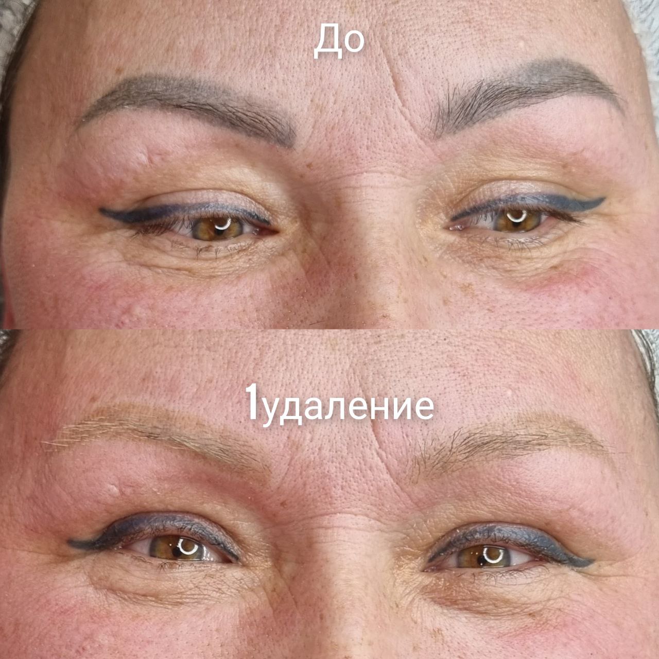 Удаление татуировок и перманентного макияжа - Красота и здоровье в Сургут