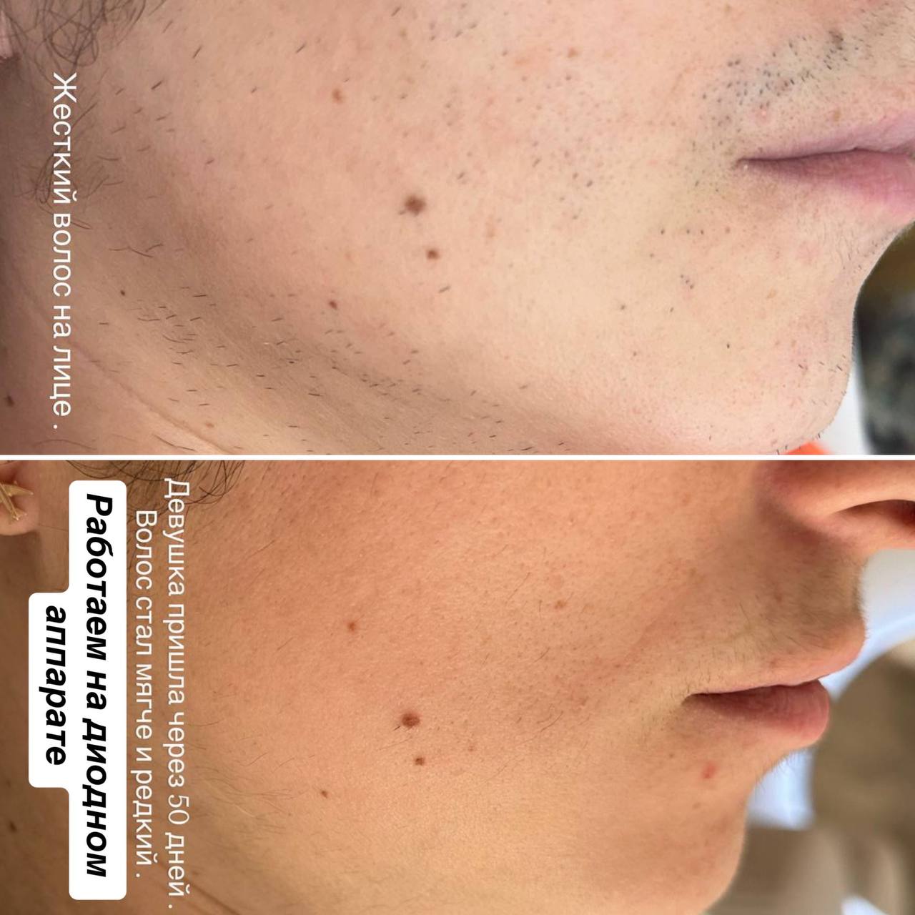 Лазерная эпиляция и косметологические услуги - Красота и здоровье в Балашиха