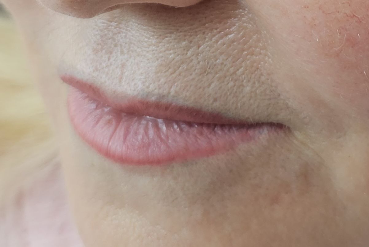 Удаление неудачного перманента или тату - Красота и здоровье в Калининград - фото 3