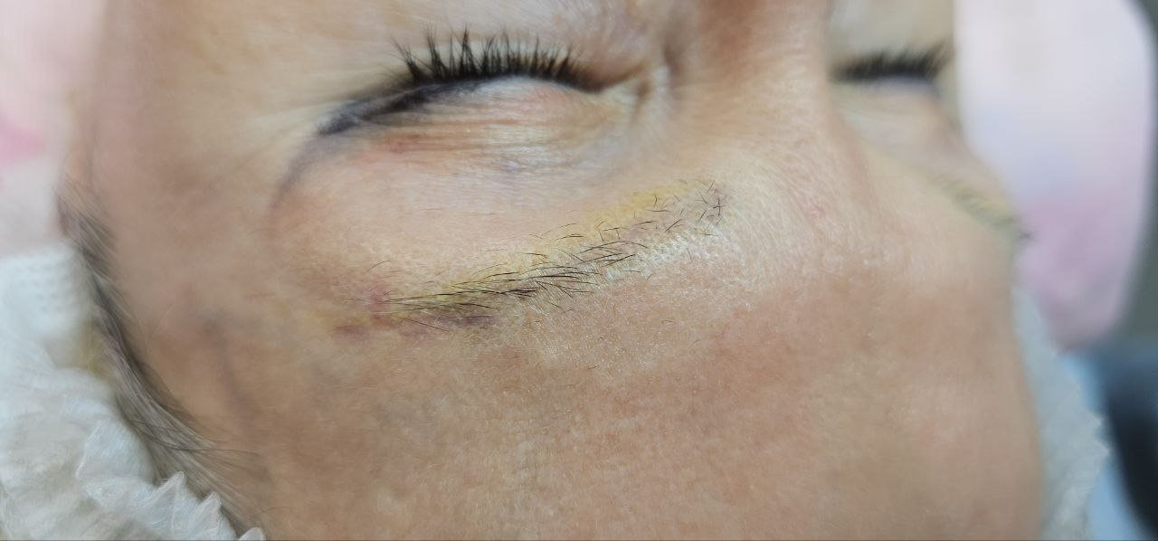 Удаление неудачного перманента или тату - Красота и здоровье в Калининград - фото 4