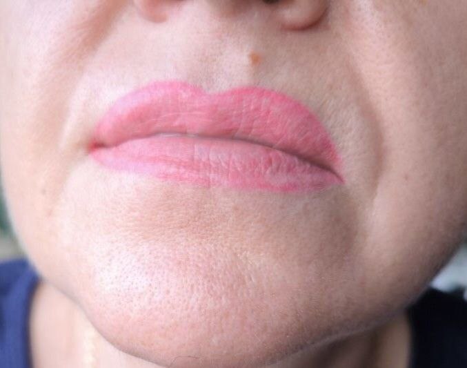 Удаление неудачного перманента или тату - Красота и здоровье в Калининград - фото 5