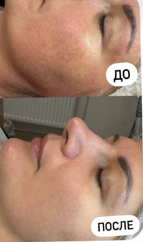 Карбоновый пилинг - акционное предложение - Красота и здоровье в Саратов - фото 2