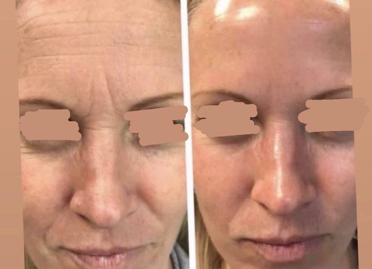 Карбоновый пилинг - акционное предложение - Красота и здоровье в Саратов - фото 3