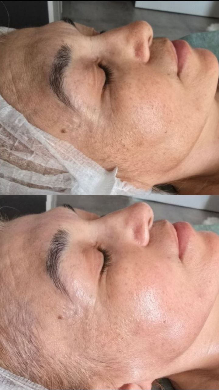 Процедура-бестселлер BIOPLASMA от GIGI - Красота и здоровье в Чебоксары - фото 2