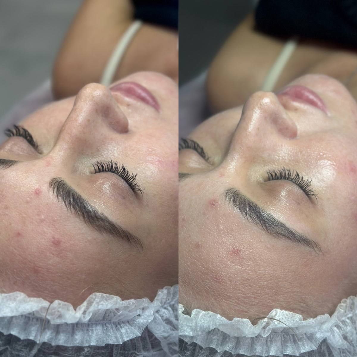 Процедура-бестселлер BIOPLASMA от GIGI - Красота и здоровье в Чебоксары - фото 3