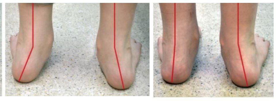 Коррекция осанки и плоскостопия у детей - Услуги в Красноярск