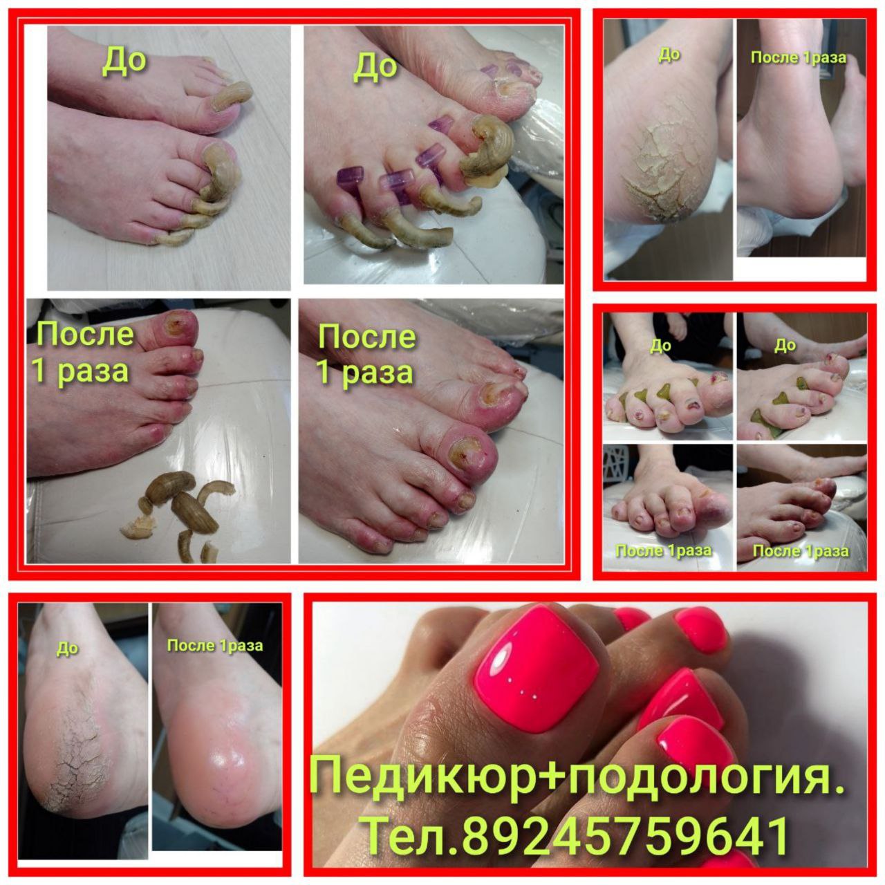 Профессиональный смарт-педикюр для проблемных стоп и ногтей - Услуги в Чита